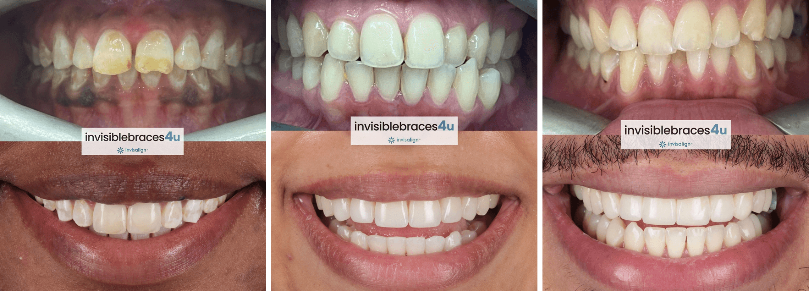Before and after Invisalign results